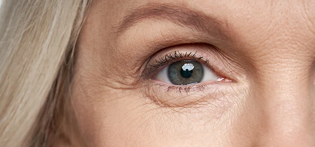 Botox gegen Krähenfüße an den äußeren Augenwinkeln
